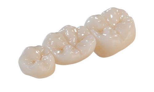 Zirconia-metal-free-wh